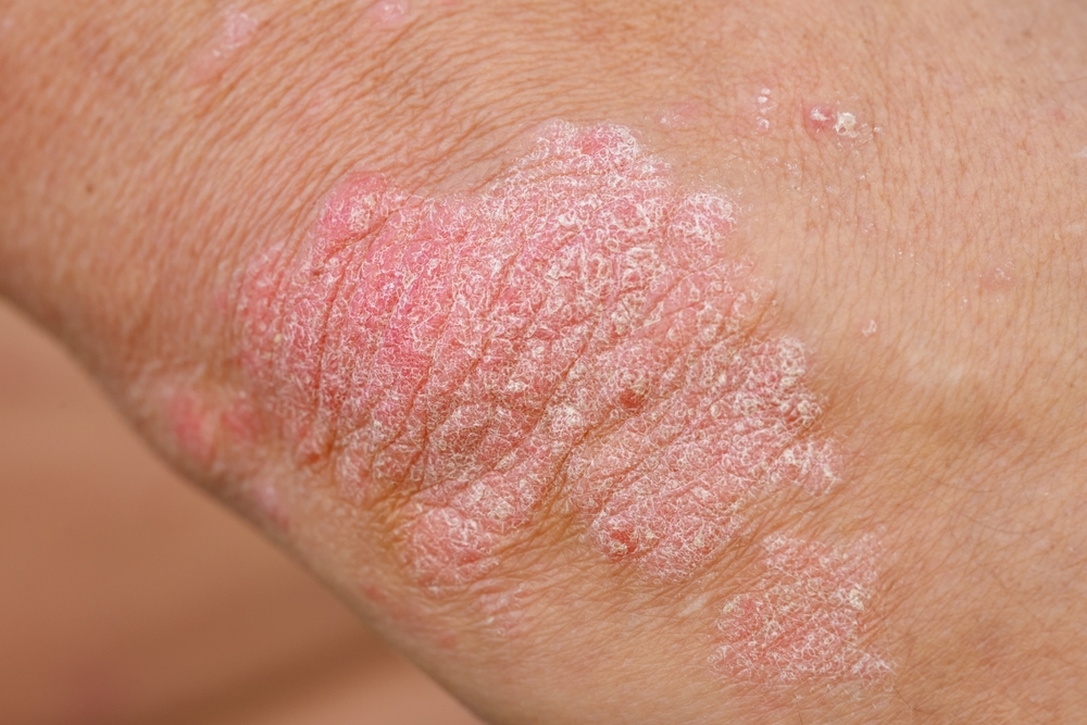 Close up of elbow with psoriasis and red dry patch on skin