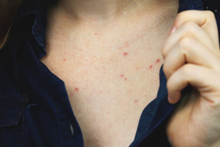 Woman with chest acne