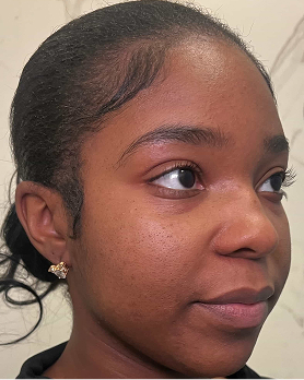 Bianca - After 3 months