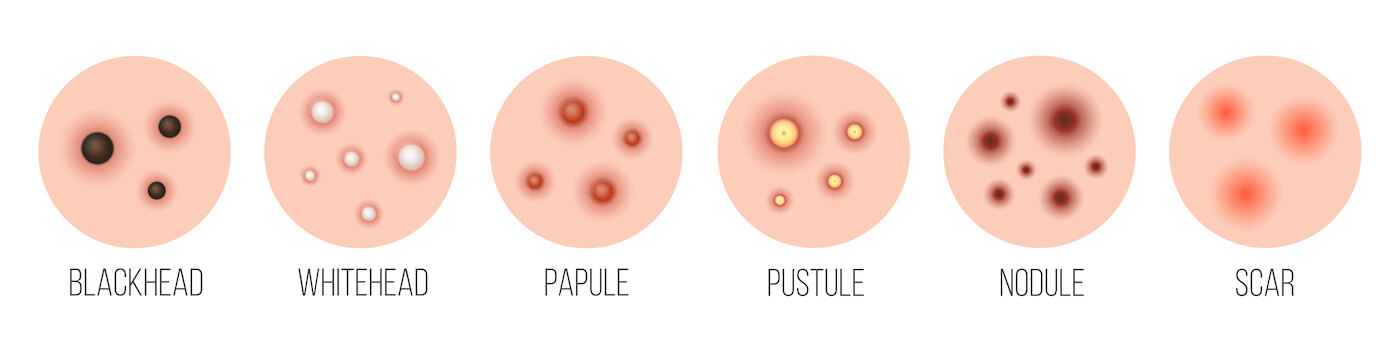Types of acne pimples