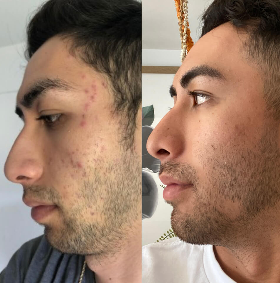 Saiah Oku-Fernandez's face Before and After Curology