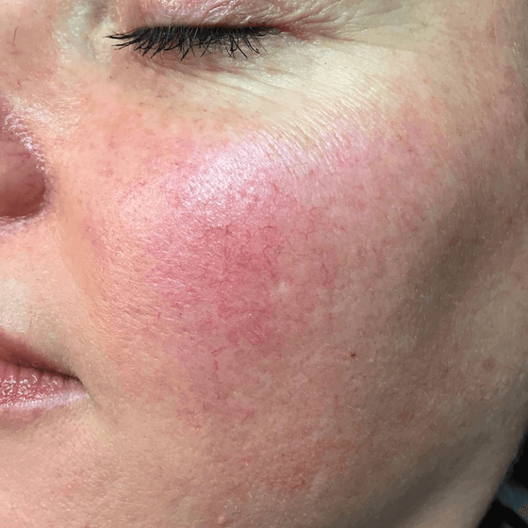 Spider Veins on the Face