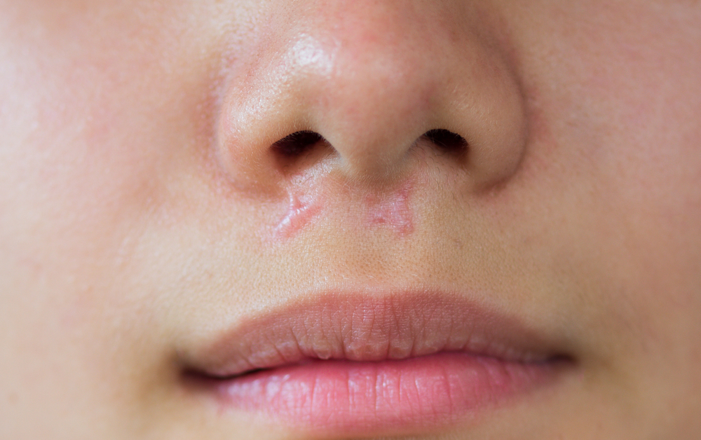 Keloid scars on face