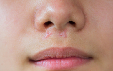True Scars What are hypertrophic scars and what causes them?