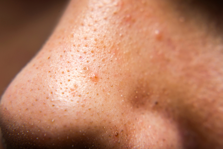 Nose acne and blackheads
