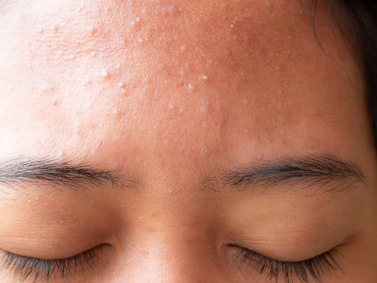 acne on forehead