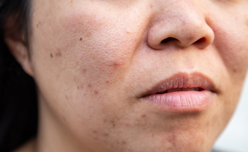 acne-on-middle-age-woman