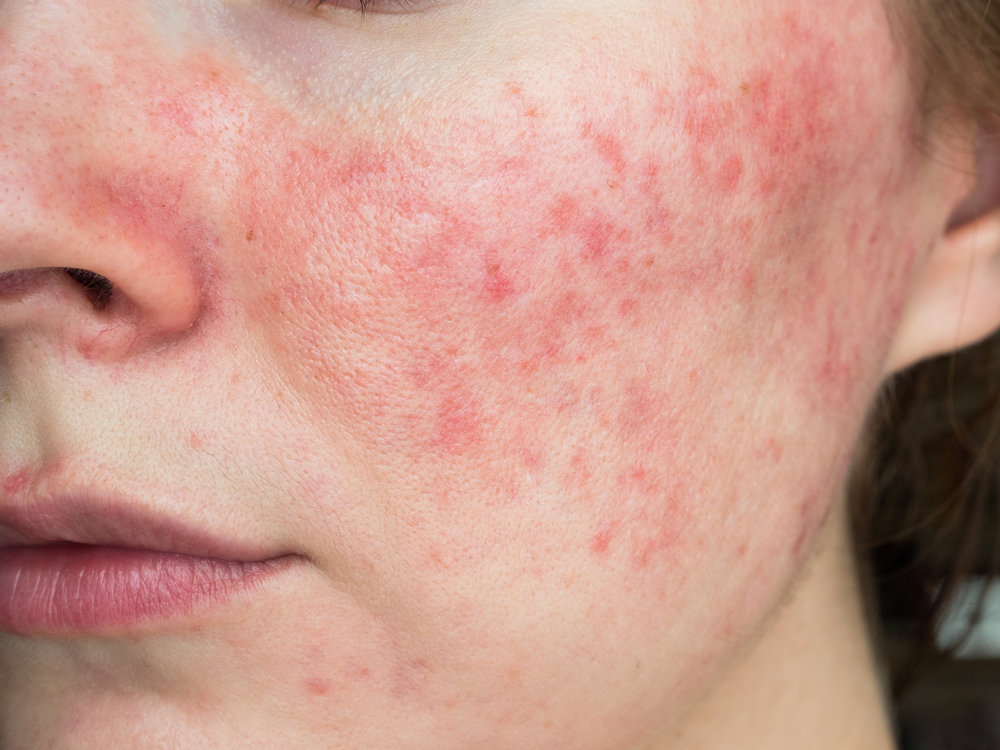 Papulopustular rosacea close patients cheek