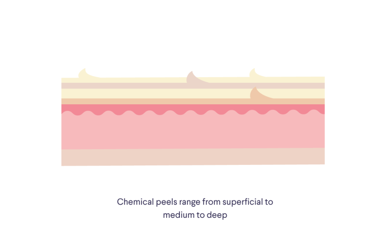 Illustration of layers of skin with text "Chemical peels range from superficial to medium to deep"