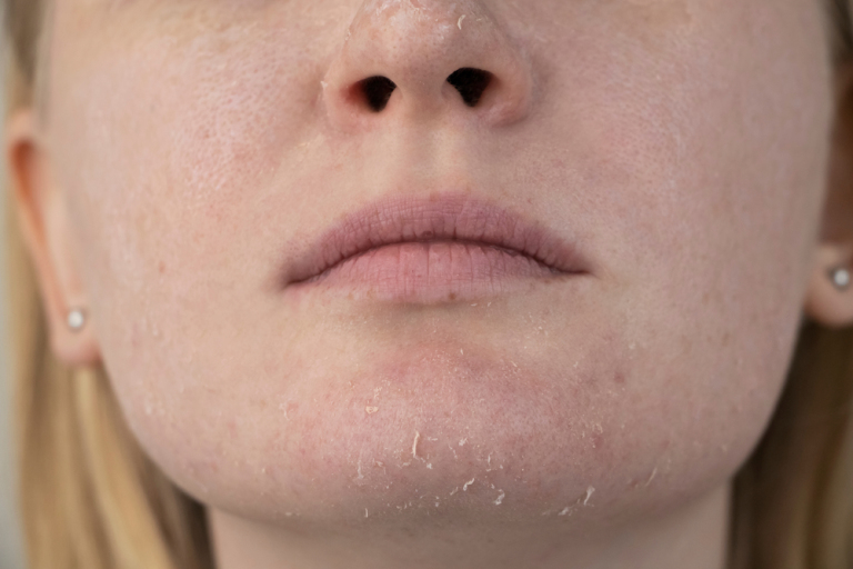 woman examines dry skin on her face
