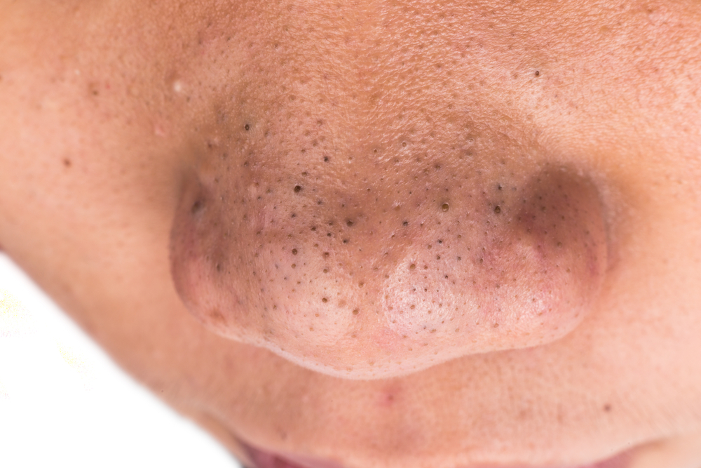 Closed pimple blackheads on nose