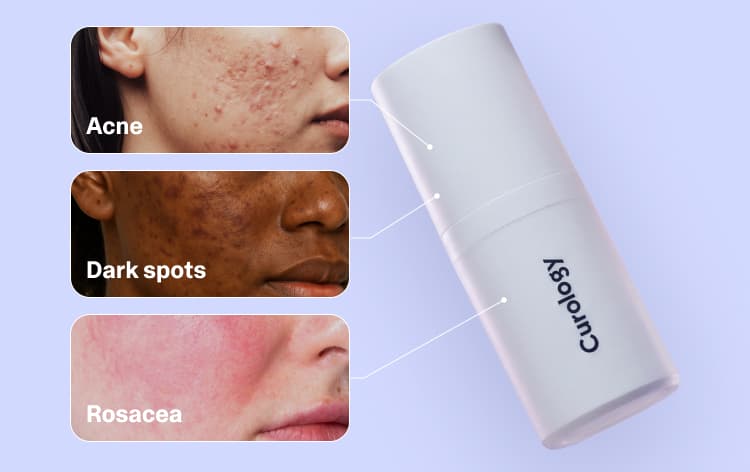 Skin concerns that can be treated with a Curology custom prescription formula