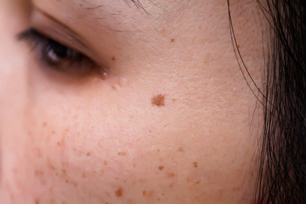 woman with acne scars on face