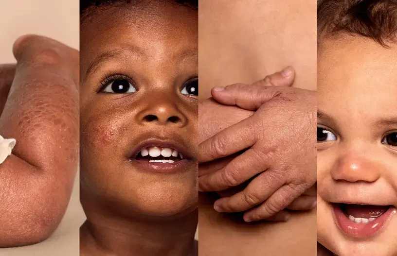 Collage of four images split vertically showing eczema on diverse babies skin