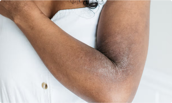 A woman with a prominent eczema condition on her arm, representing her condition