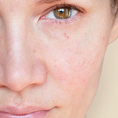 Aveeno<sup>®</sup> Redness Overview