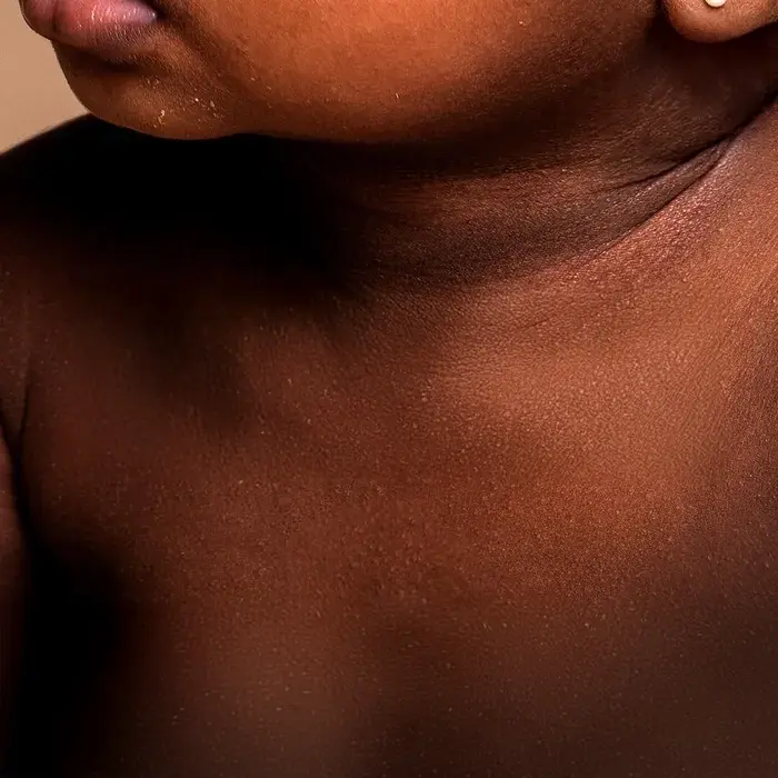 A close up image featuring a baby with eczema condition on the neck