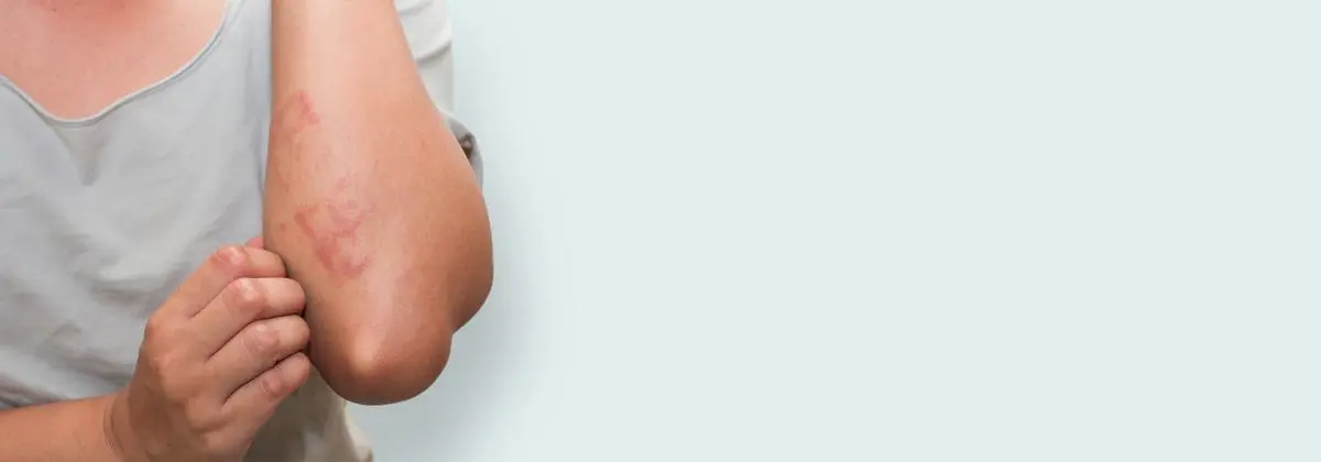 A woman's arm with striking red skin, exhibiting an unusual skin tone and symptoms of itchy skin