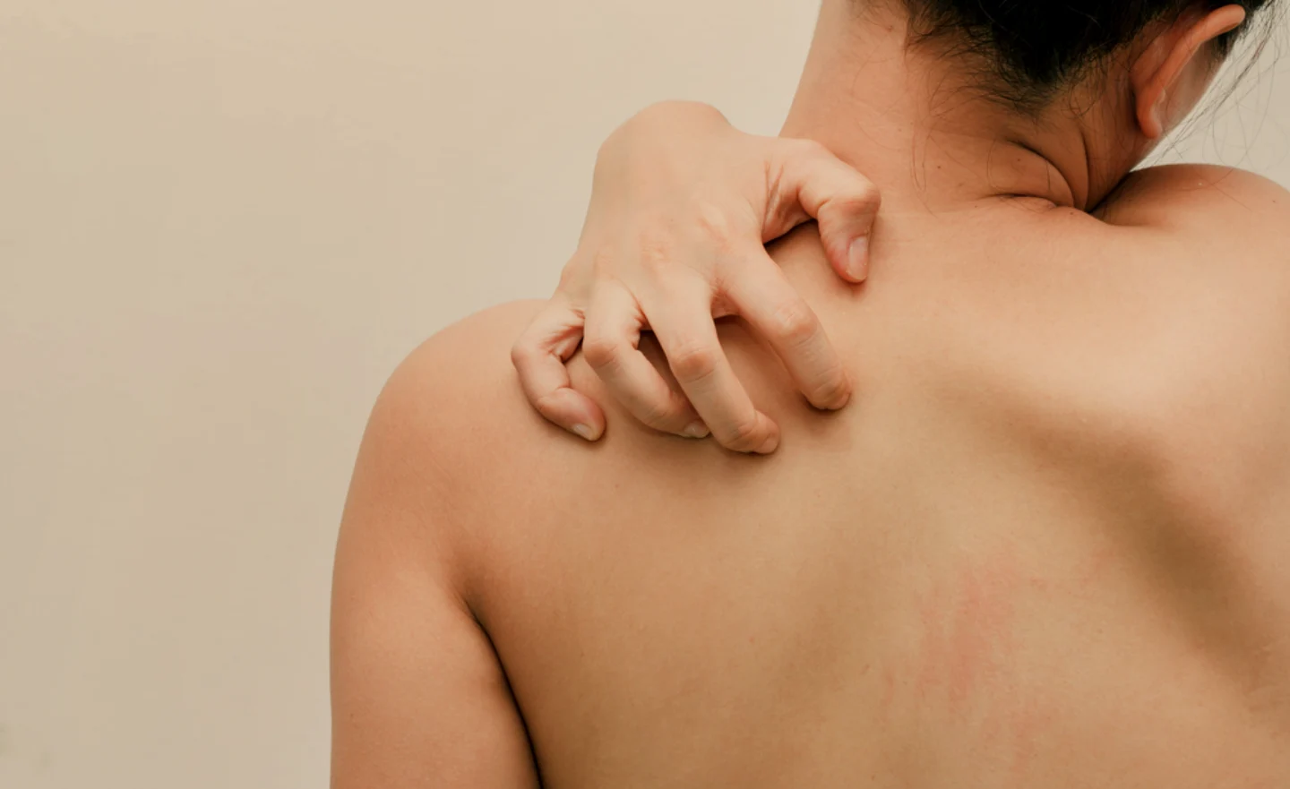 A woman scratching her left back, showing slight redness on her skin