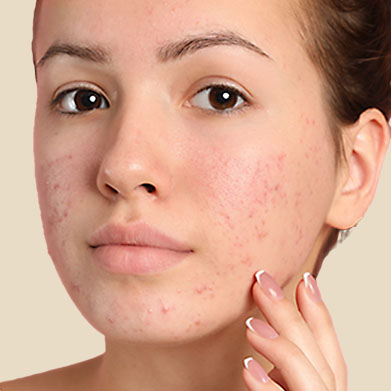 Aveeno Acne Products Overview