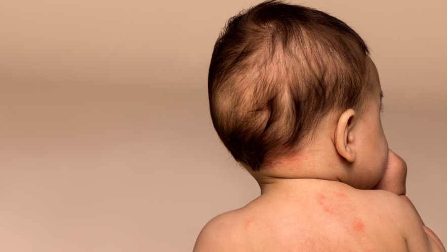 A baby sitting up facing away and back showing irritated skin.