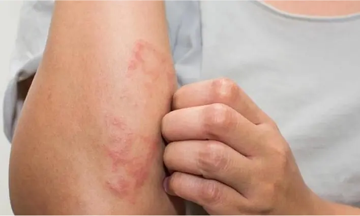 Close-up of itchy eczema rash on an arm needing soothing therapy.