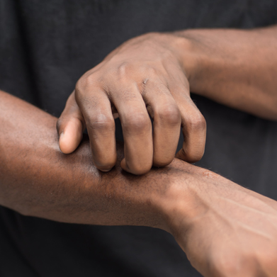 Aveeno<sup>®</sup> Itchy Skin Overview