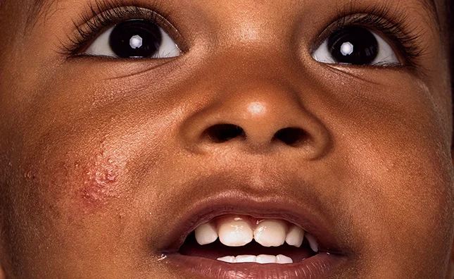 Close-up of a child with brown eyes looking up, smiling and a skin condition on their cheeks
