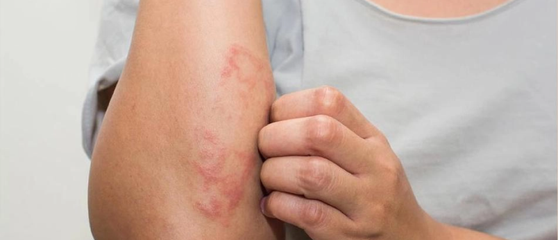 Image showing a person's arm affected by a rash illustrating the visible signs of skin itchy