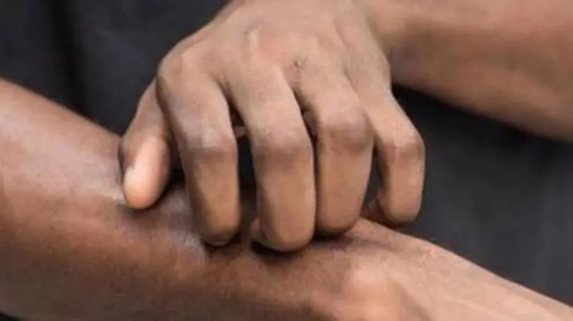 Scratching arm with eczema