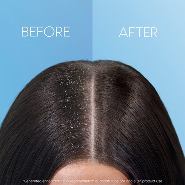 The comparison image: a scalp with dandruff before and the scalp without dandruff after.