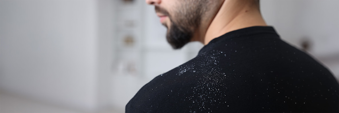 An older bearded man in a dark sweater with visible white flakes on his shoulder.