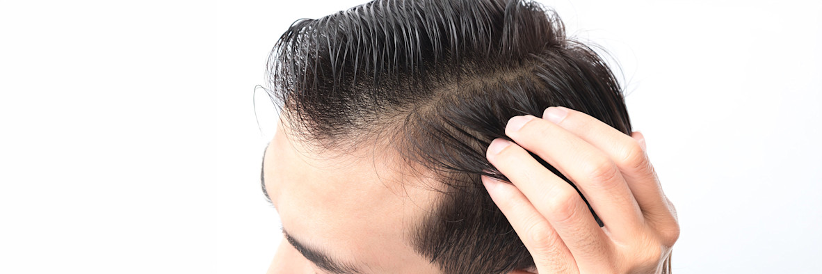 Close-up of a man's scalp showing a neat hair parting with fine dark hair.