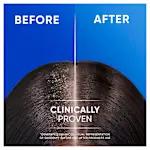 Infographic: Women's hair BEFORE and AFTER using Head&Shoulders shampoo on her hair; *GENERATED ENHACED VISUAL REPRESENTATION OF DANDRUFF BEFORE AND AFTER PRODUCTS USE