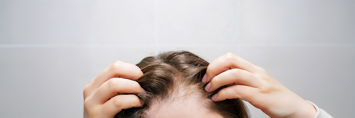 A close-up of a scalp parting clearly showing white dandruff flakes between hair strands.