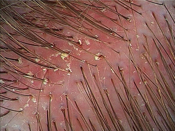 The image of zoomed head scalp showing skin inflammation.