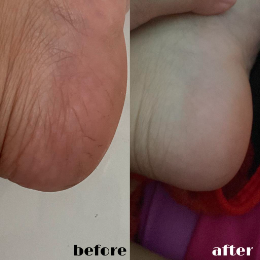 Before After Body Saver 2