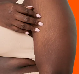 Stretch_Marks