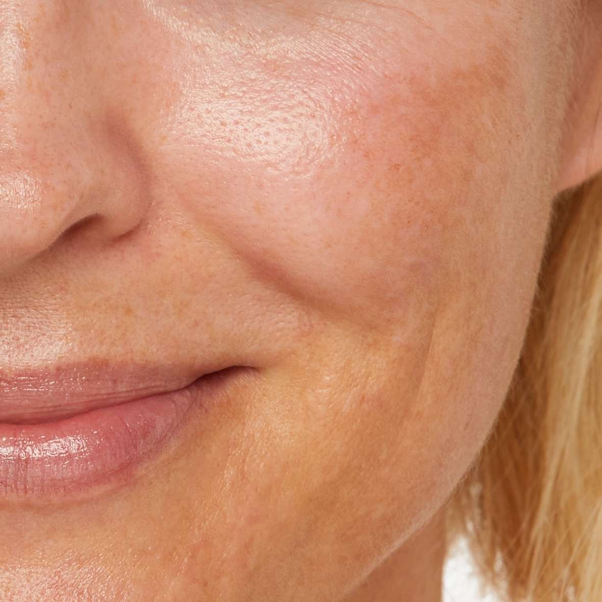 The different types of pigmentation explained 