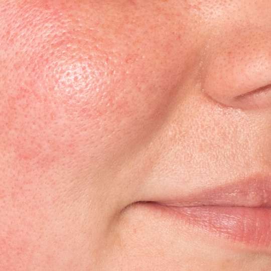What is rosacea? A deep dive into this complex condition