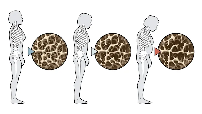 2759266-Osteoporosi-illustrazione-sintomi (ITA)