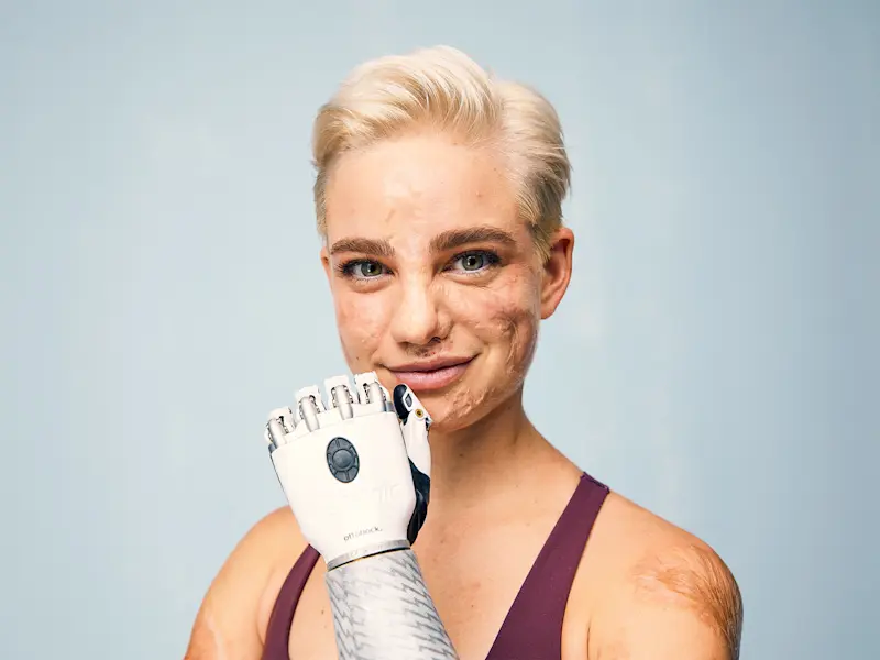 Primo piano della campionessa olimpica Bebe Vio con la mano bionica Ottobock Bebionic