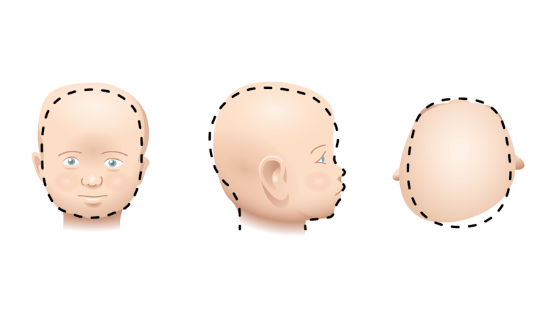 OC - Pediatrics Cranial Helmets_Signs to Look For_Image (US)
