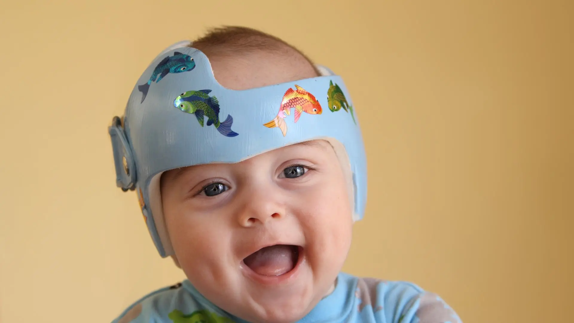 An adolescent wearing a customized orthotic cranial helmet