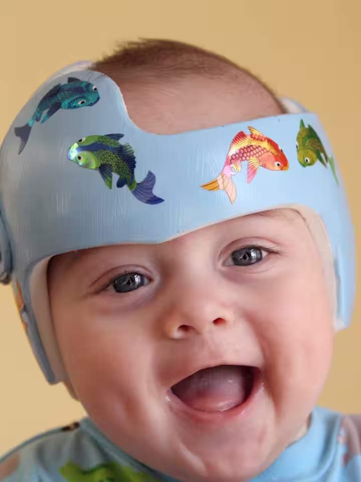 A child wearing a custom cranial helmet