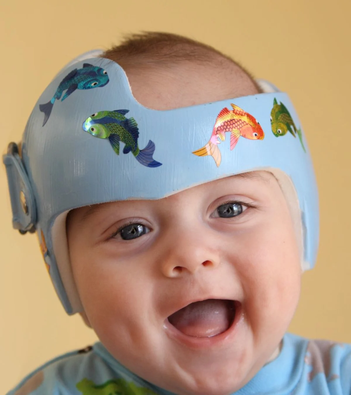 A child wearing a custom cranial helmet