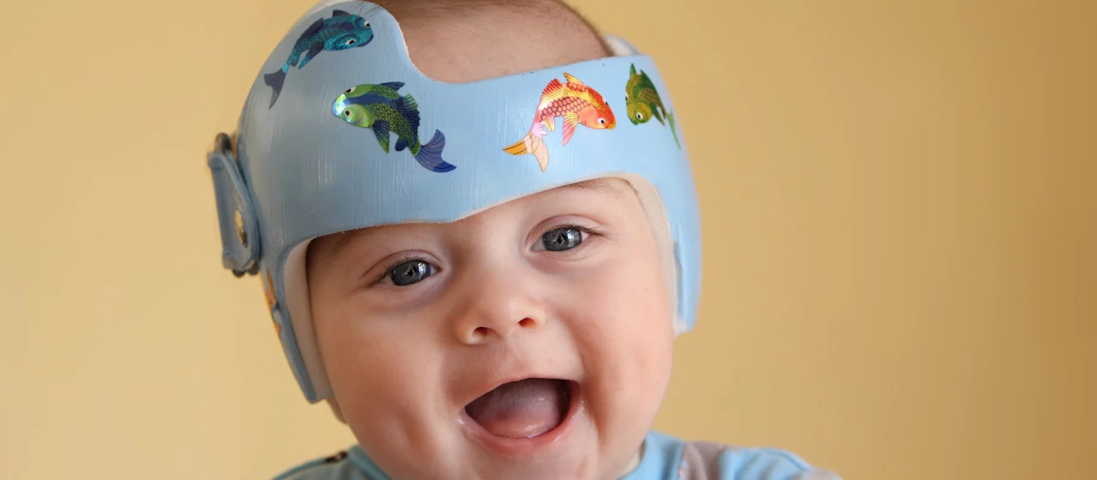 A child wearing a custom cranial helmet