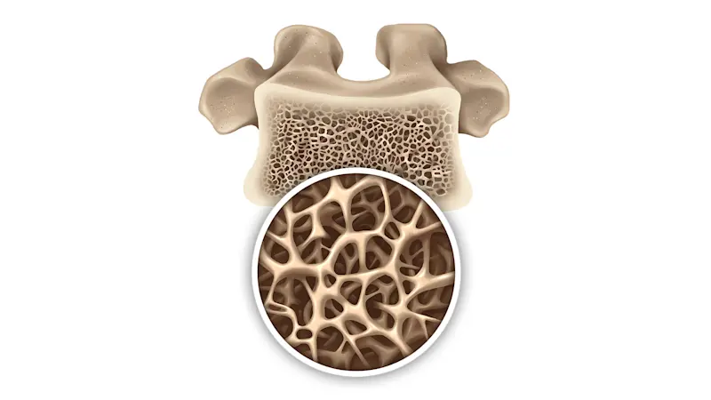 2759274-Osteoporosi-illustrazione-osso (ITA)