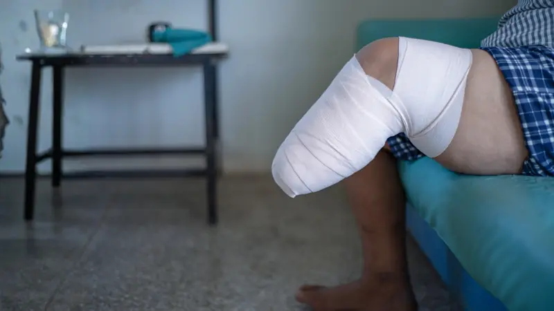 An amputee wrapping their residual limb in a compression