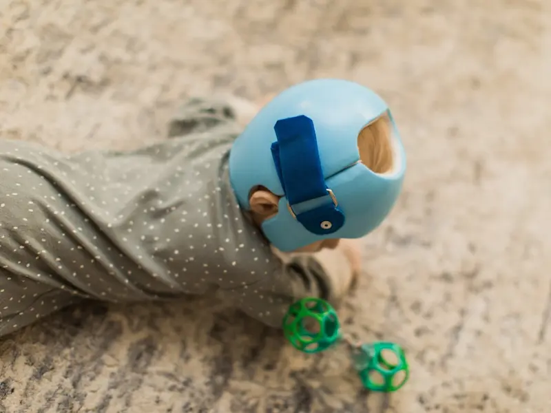 An  infant in a cranial helmet
